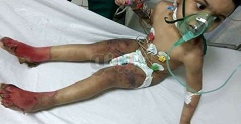 محافظة كفر الشيخ تتكفل بعلاج الطفل ضحية التعذيب (خبر)