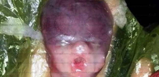 سيدة وزوجها يتهمان طبيبا بـ"شطر الجنين نصفين".. و"صحة أسوان": كان ميت (خبر)