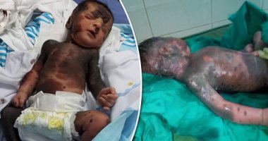 مأساة أسرة.. "محمد" عمره أيام وجسده ينزف دما وجلده يتساقط.. مصاب بضمور فى القدم اليمنى.. أحد الأطباء: مصاب بوحمة دموية.. وآخر: سيتوفى فى وقت قريب.. ووالدته: "ماحدش عارف علاجه إيه وجسمه زى المحروق" (ريبورتاج)