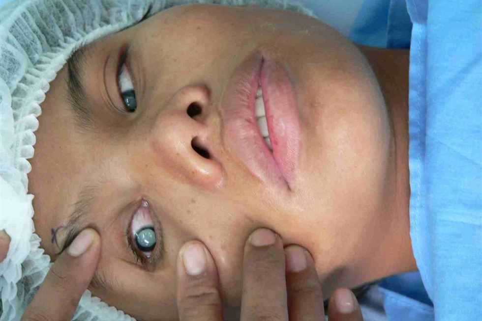 عميد «قصر العيني» يرد على مزاعم «سرقة قرنية مريض قبل وفاته» (فيديو)