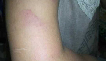 تفاصيل تعذيب طفلة الساحل الشمالي: أسرة قامت بتعذيب خادمة عمرها 10 سنوات | المصري اليوم