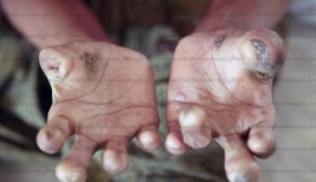 الجـــذام.. لعنة مجتمعية لا تسقط بالتقادم
