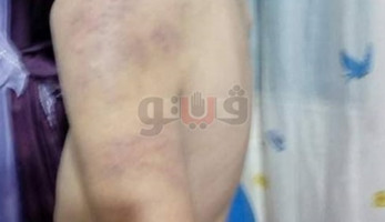 مأساة الطفل إياد ضحية تعذيب زوجة الأب بالإسماعيلية (صور)