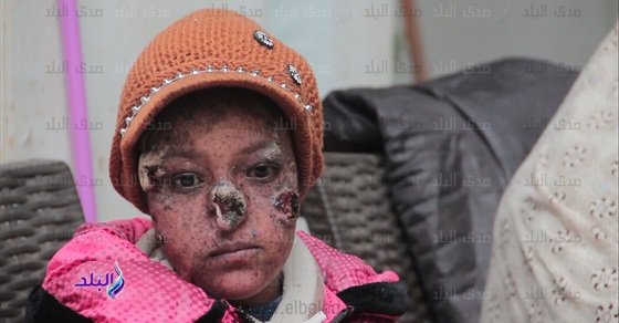 الشمس تأكل وجهها .. مرض نادر يغتال طفولة سلمى ويعرضها للتنمر .. فيديو وصور