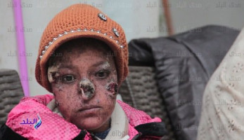 الشمس تأكل وجهها .. مرض نادر يغتال طفولة سلمى ويعرضها للتنمر .. فيديو وصور