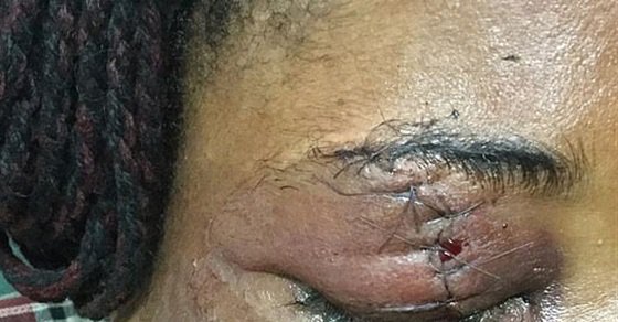 إزالة خصلة شعر من عين سيدة بعد فقعها بزجاجة.. صور