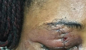إزالة خصلة شعر من عين سيدة بعد فقعها بزجاجة.. صور