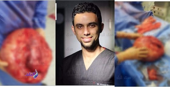 طبيب مصري يستأصل ورما بوزن 14 كجم