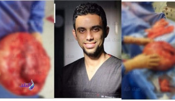 طبيب مصري يستأصل ورما بوزن 14 كجم
