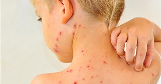فساد تطعيمات الحصبة والحصبة الألمانية بالمدارس.. الحكومة ترد