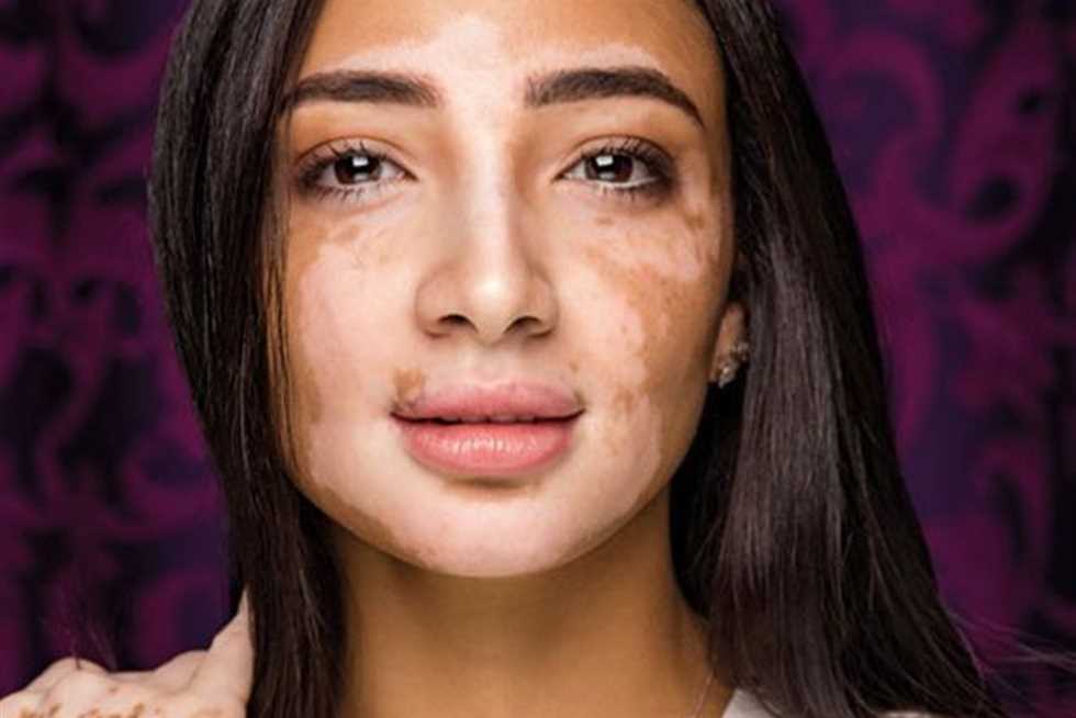 «لجين صلاح».. مصرية تحدّت البُهاق وأصبحت مراسلة تليفزيونية