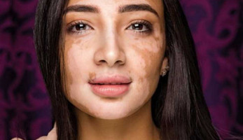 «لجين صلاح».. مصرية تحدّت البُهاق وأصبحت مراسلة تليفزيونية
