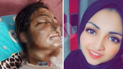 عامل يلقى مياه نار على خطيبته ويفر هاربا فى القليوبية