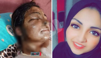 عامل يلقى مياه نار على خطيبته ويفر هاربا فى القليوبية