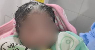 الرضيعة والشعر الأبيض.. ولادة نادرة لطفلة بخصلات شعر بيضاء فى الأقصر