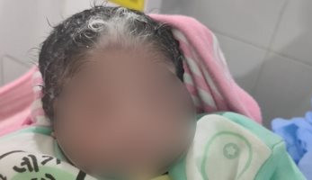 الرضيعة والشعر الأبيض.. ولادة نادرة لطفلة بخصلات شعر بيضاء فى الأقصر