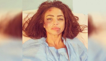 صور| دوللي شاهين تتعرض للضرب من مجهولين
