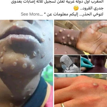 رصد ثلاث حالات مصابة بجدري القرود في المغرب