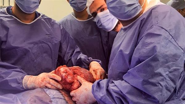 نجاح استئصال ورم بالصدر يزن 4 كيلوجرامات بمستشفيات جامعة المنوفية
