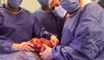 نجاح استئصال ورم بالصدر يزن 4 كيلوجرامات بمستشفيات جامعة المنوفية