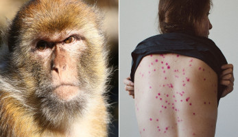 «الصحة» تعلن عن أول حالة إصابة بفيروس جدري القردة في مصر