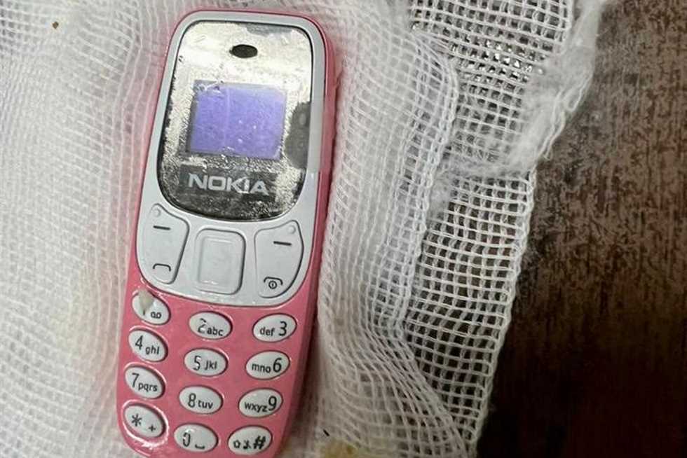 فريق طبي ينجح في استخراج هاتف محمول من معدة شاب بمستشفى الطوارئ بطنطا